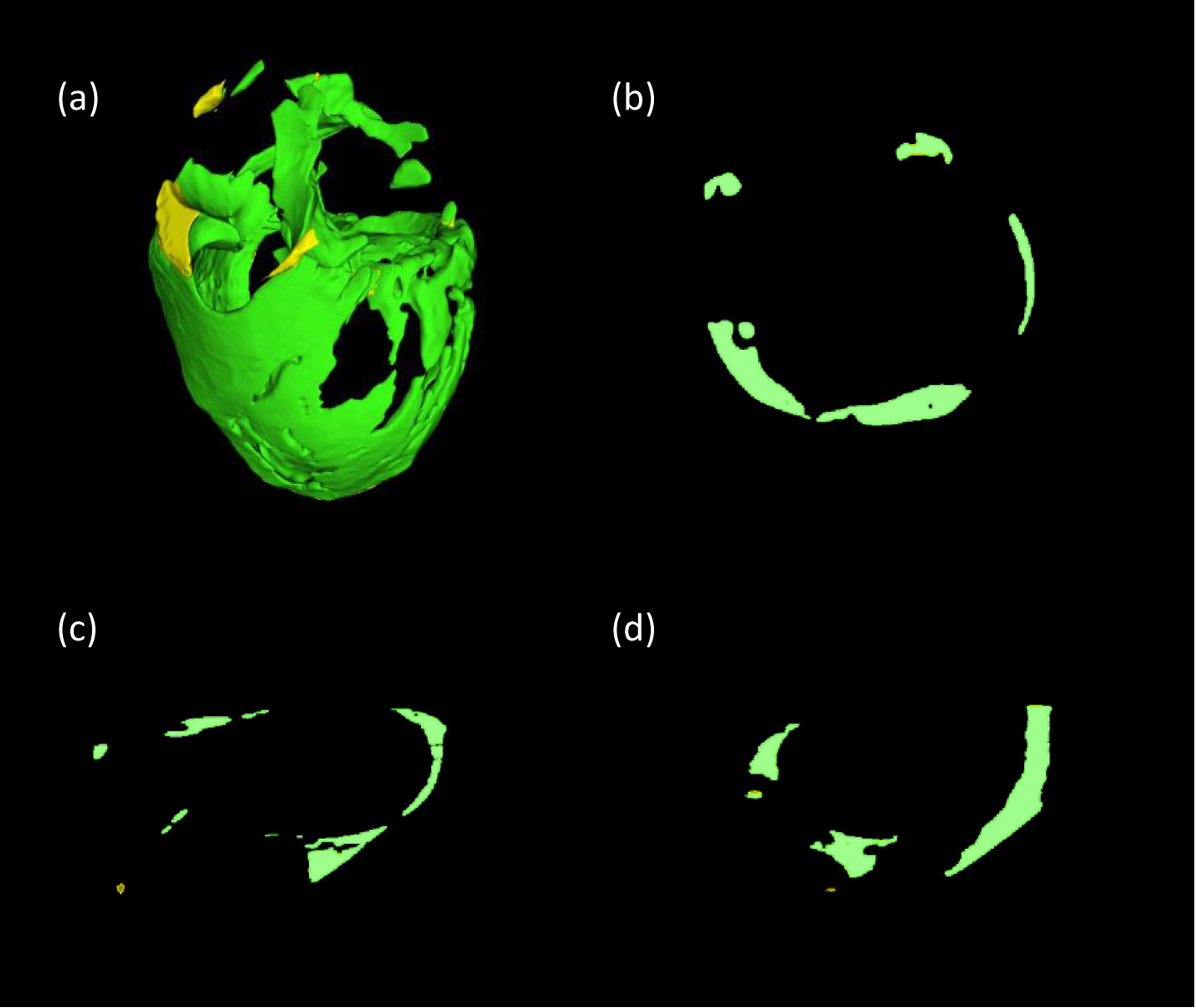 Automatic segmentation and quantification of epicardial adipose tissue ...