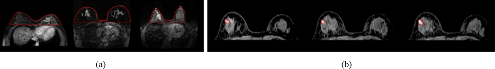 Cross-modality image feature fusion diagnosis in breast cancer - IOPscience