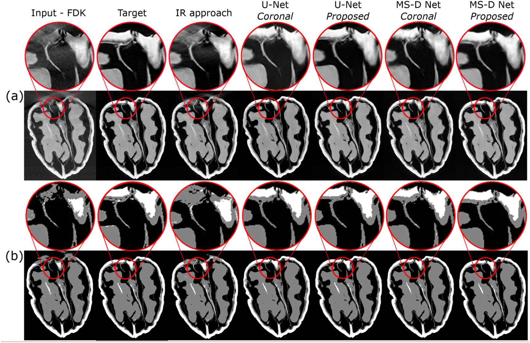 Efficient high cone-angle artifact reduction in circular cone-beam CT ...