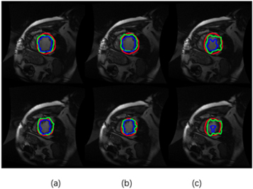Medical image segmentation with generative adversarial semi-supervised ...