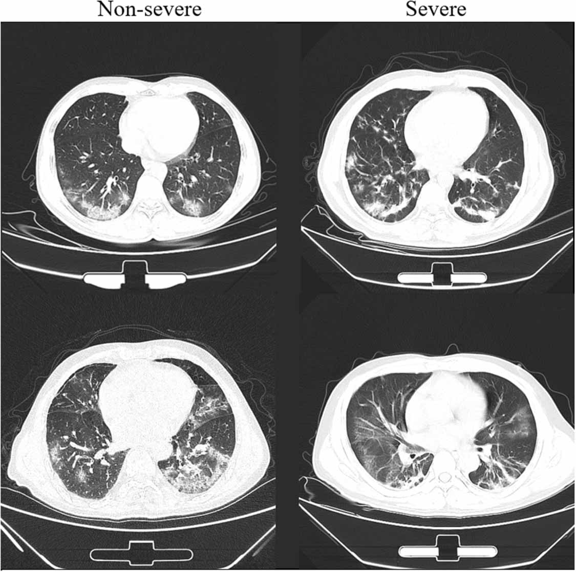 Severity assessment of COVID-19 using CT image features and laboratory ...