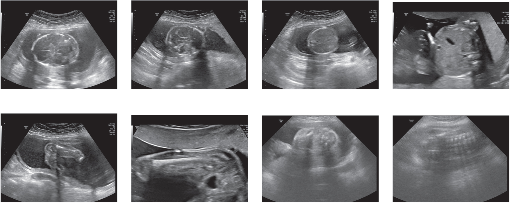 Deep learning fetal ultrasound video model match human observers in ...