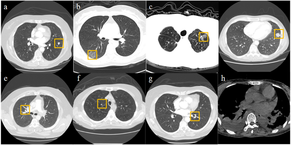 Computer-aided detection of pulmonary nodules based on convolutional ...