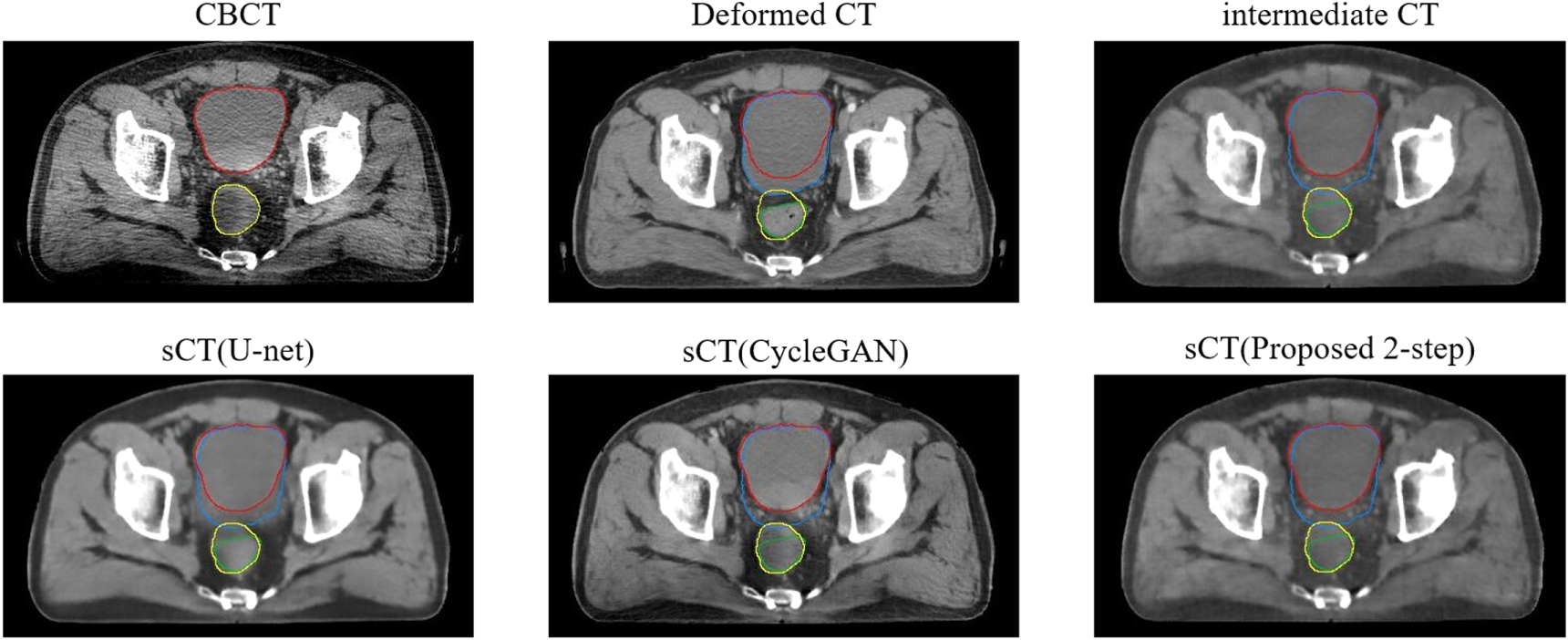 A two-step method to improve image quality of CBCT with phantom-based ...