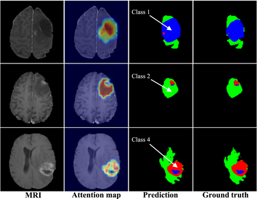 Category guided attention network for brain tumor segmentation in MRI ...