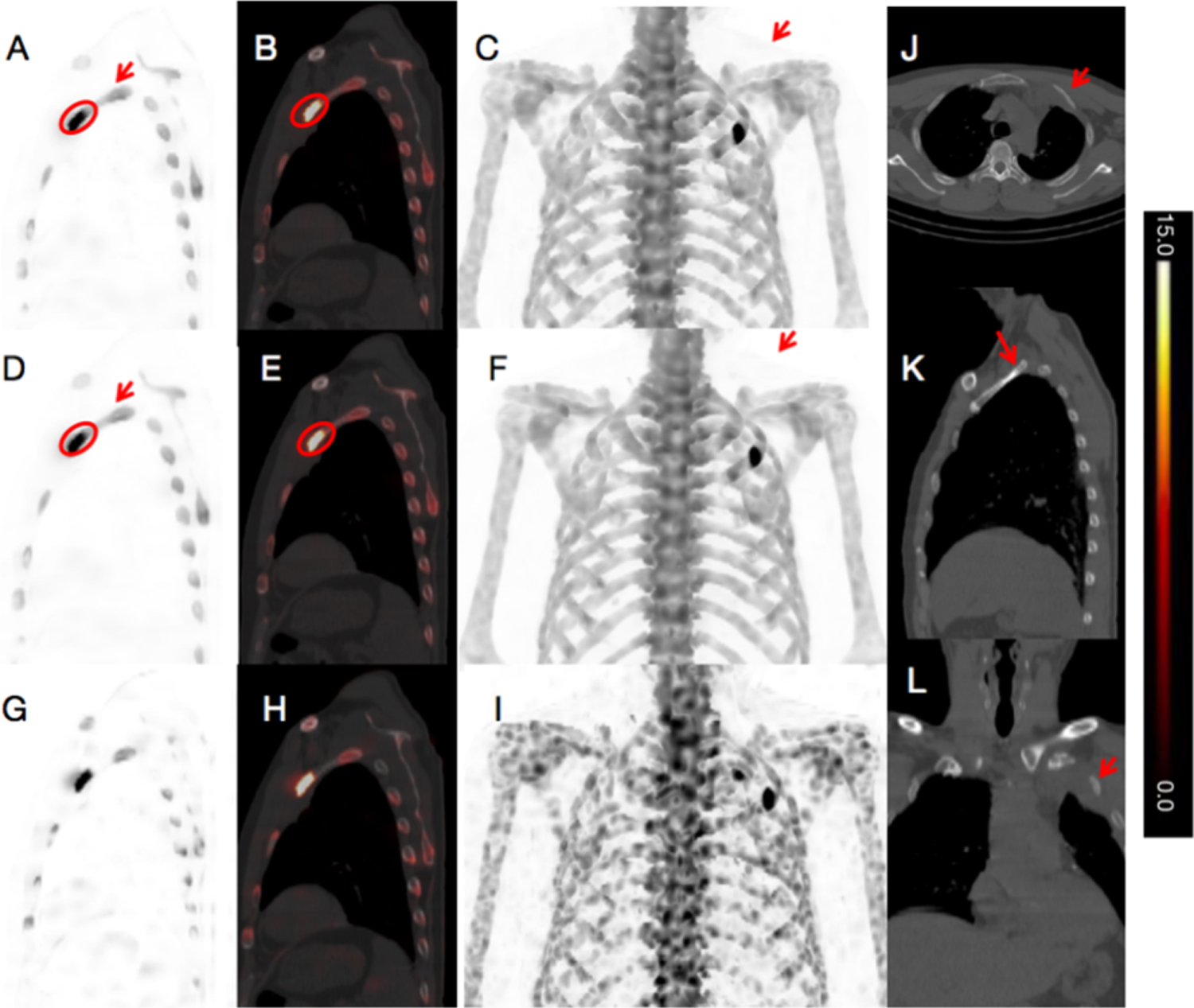 Deep learning enhanced ultra-fast SPECT/CT bone scan in patients with ...