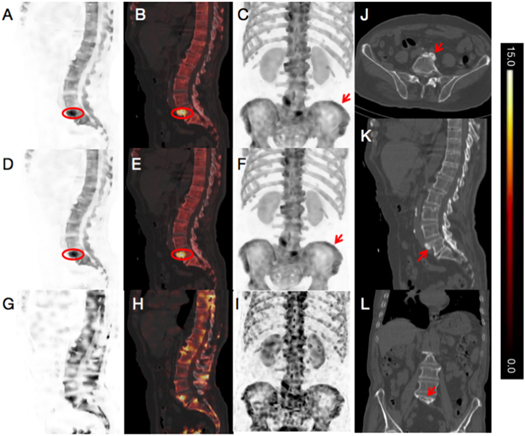 Deep learning enhanced ultra-fast SPECT/CT bone scan in patients with ...