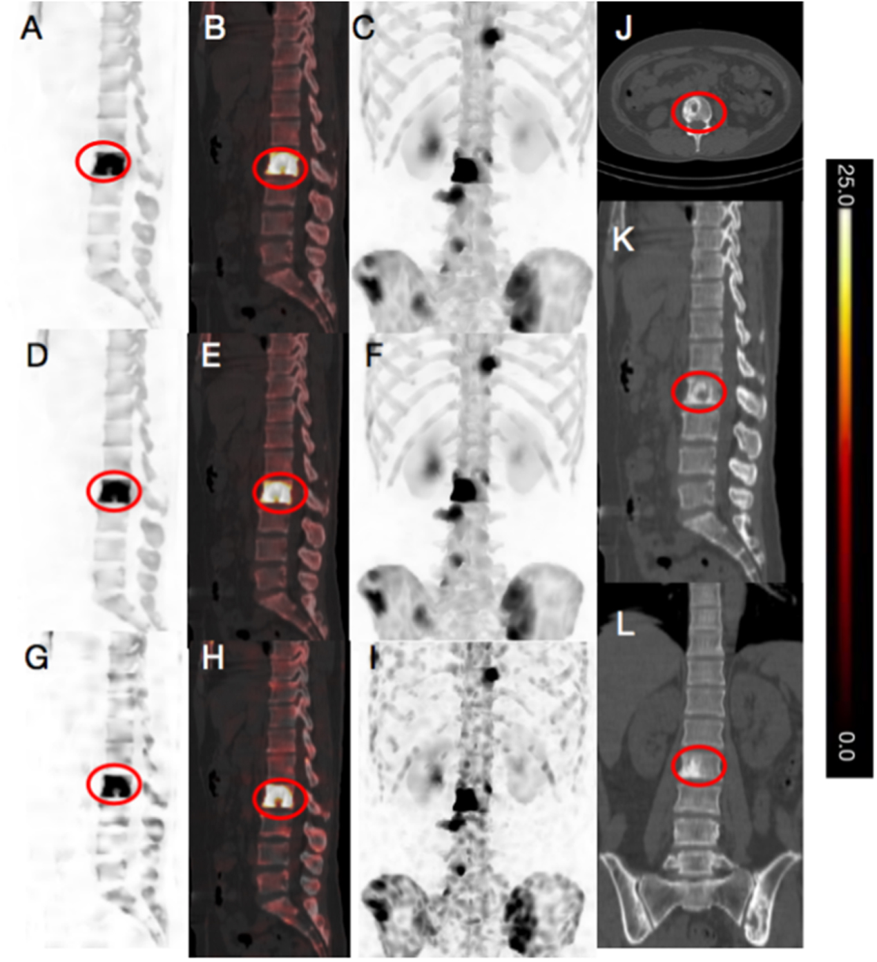 Deep learning enhanced ultra-fast SPECT/CT bone scan in patients with ...