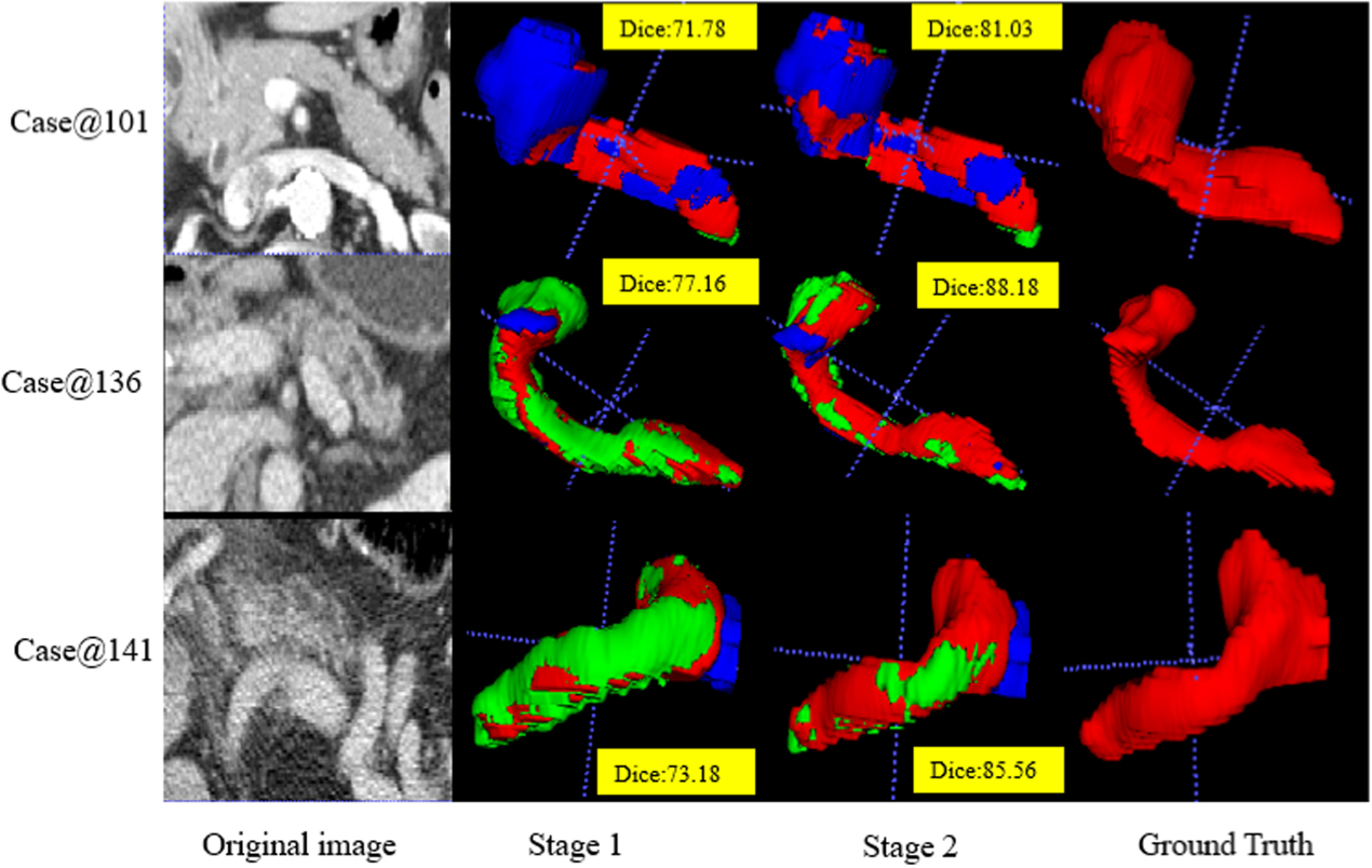 A two-stage data-model driven pancreas segmentation strategy embedding ...