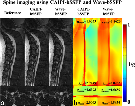 Recent advances in highly accelerated 3D MRI - IOPscience