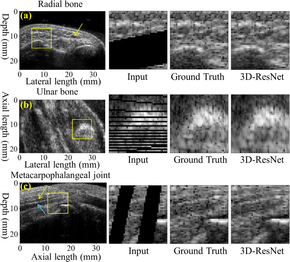 Three-dimensional ultrasound image reconstruction based on 3D-ResNet in ...
