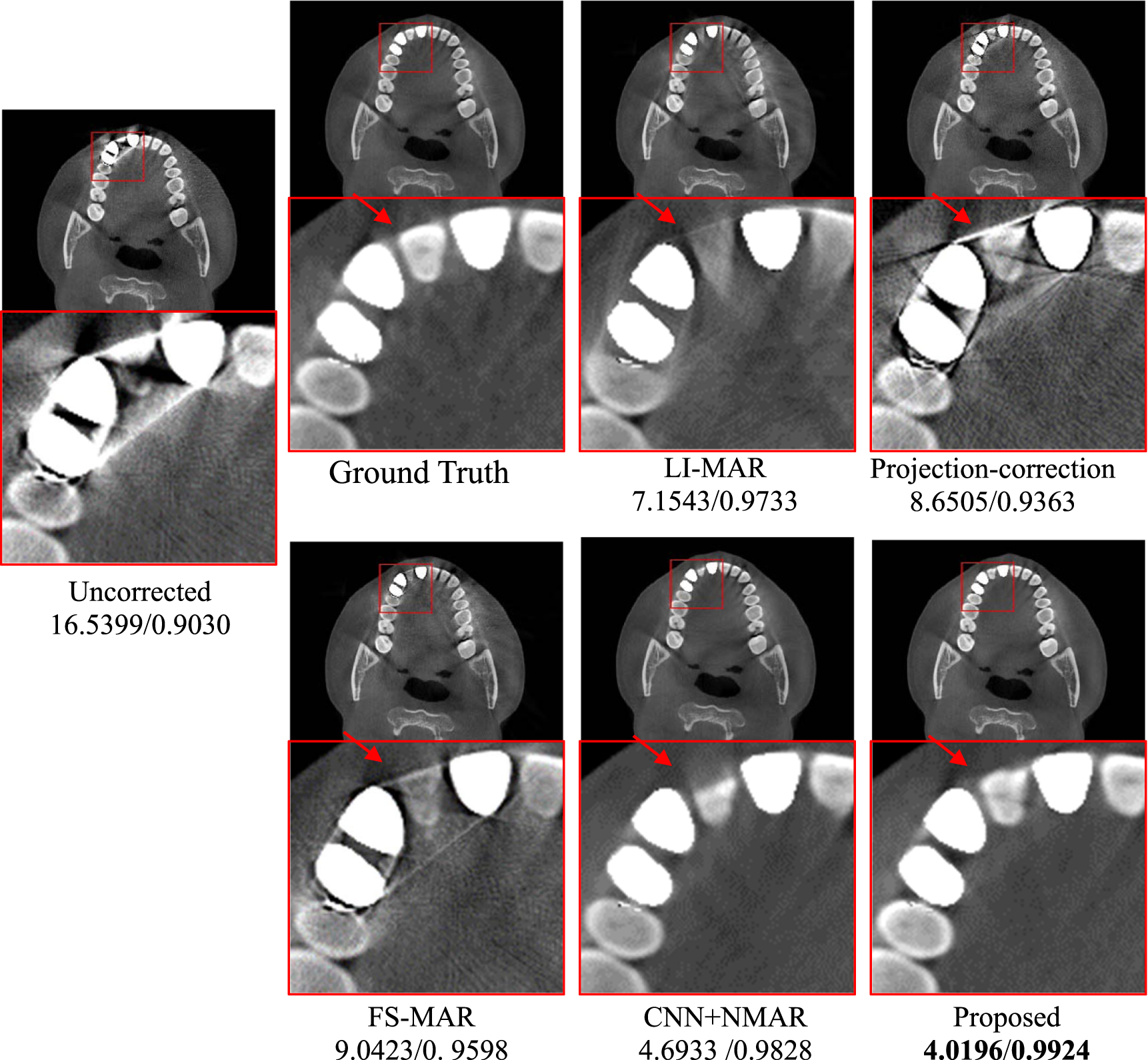 A new dental CBCT metal artifact reduction method based on a dual ...