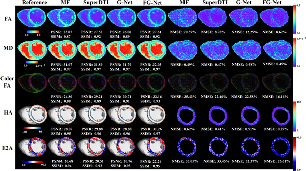 Accelerated cardiac diffusion tensor imaging using deep neural network ...