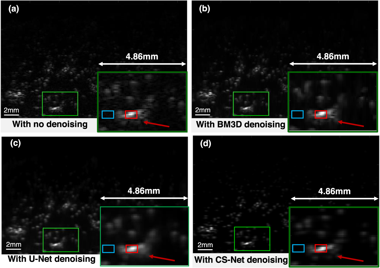 Deep learning for fast denoising filtering in ultrasound localization ...