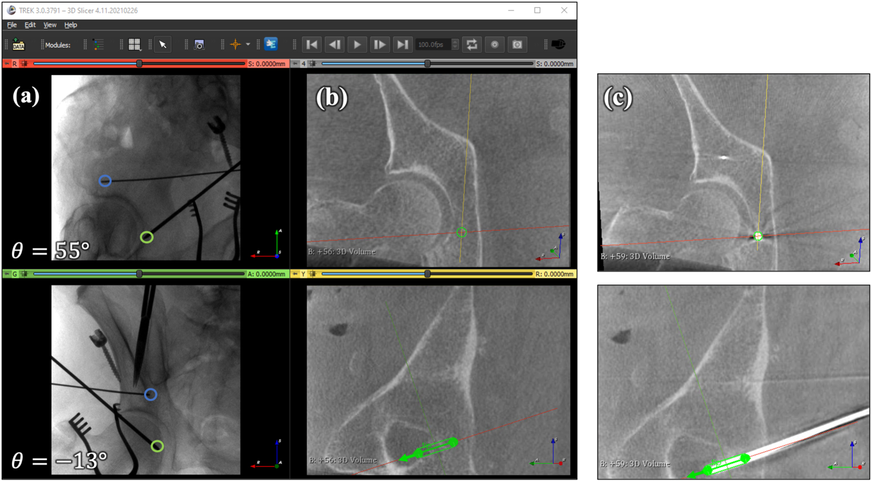 Surgical navigation for guidewire placement from intraoperative