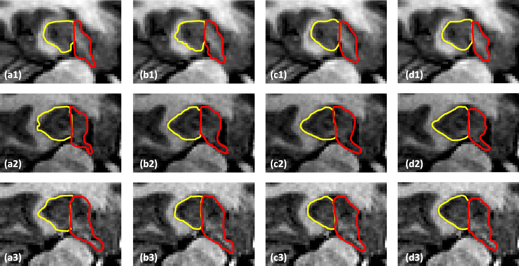 Hippocampus substructure segmentation using morphological vision ...