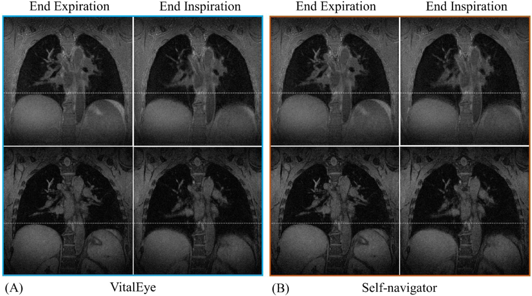 Isotropic Resolution 4D lung MRI with high-isotropic-resolution using half-spoke (UTE) and ...