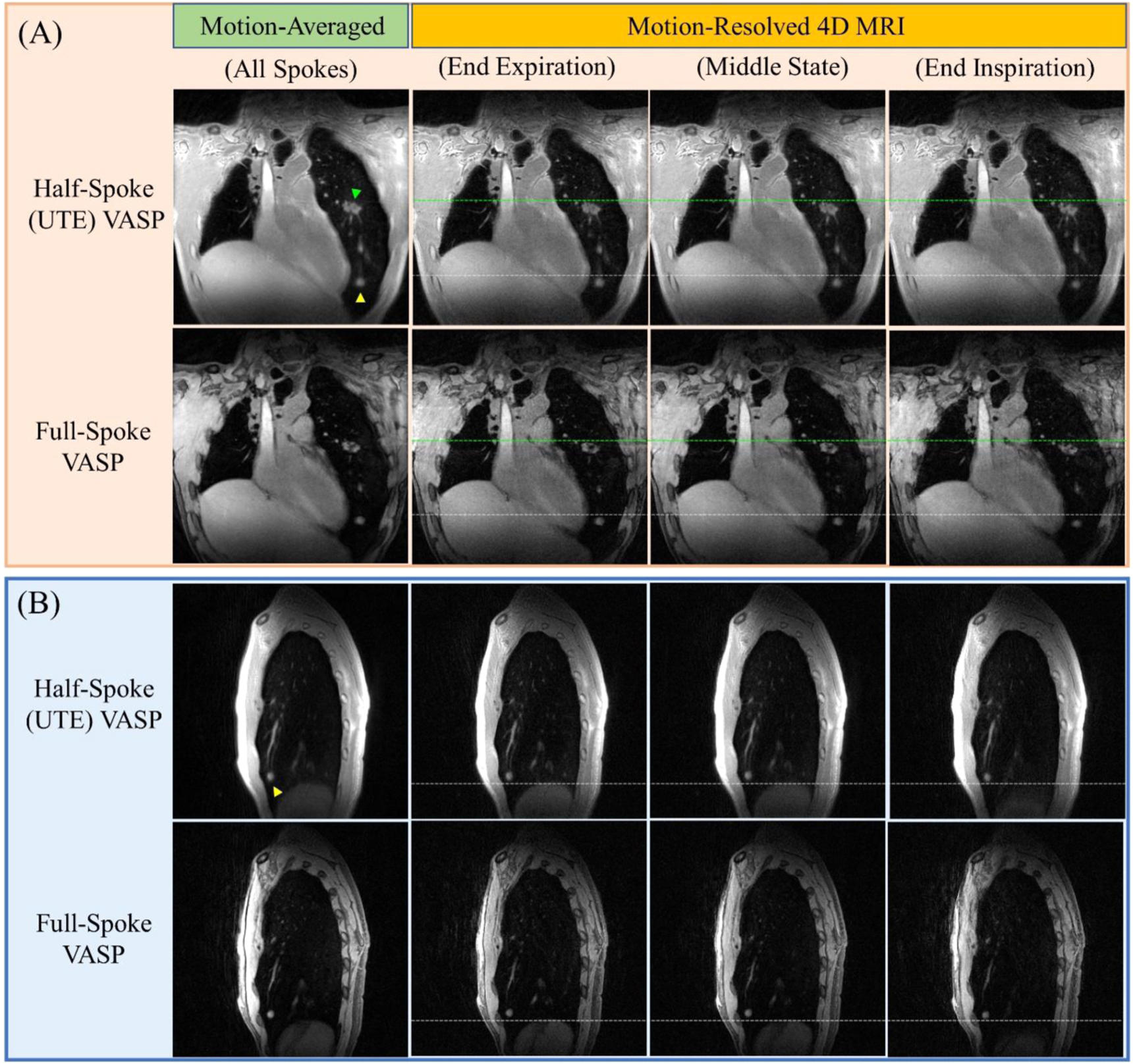 Isotropic Resolution 4D lung MRI with high-isotropic-resolution using half-spoke (UTE) and ...