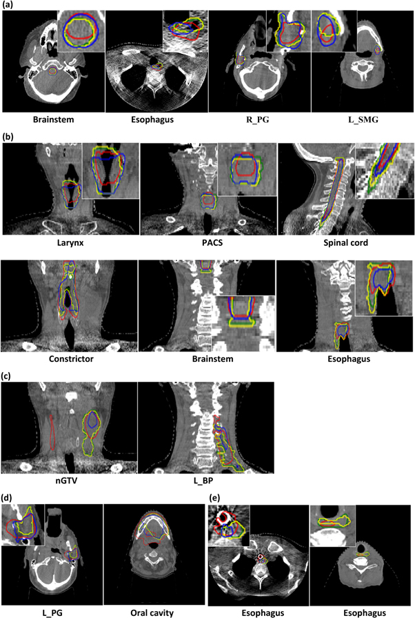 Deep learning based direct segmentation assisted by deformable image ...