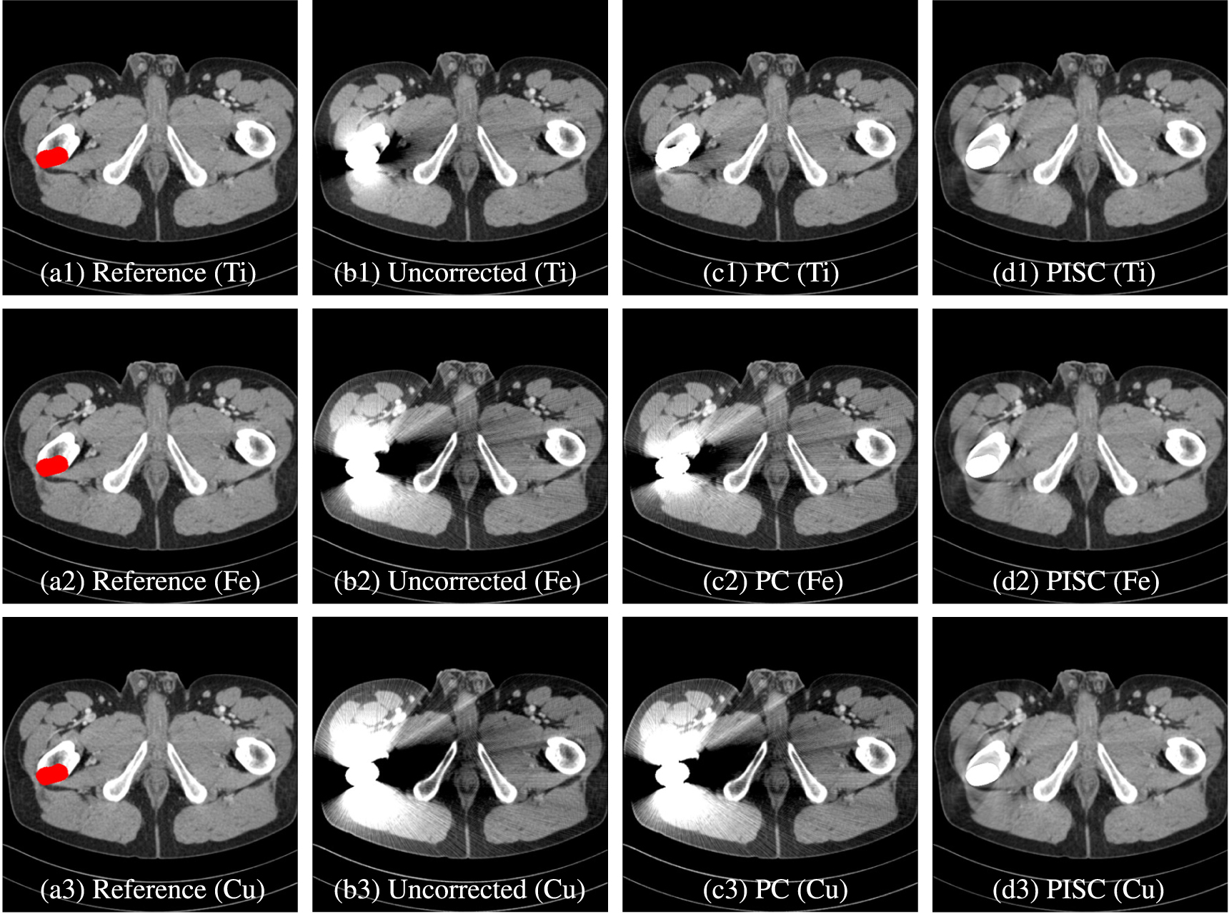 Physics-informed sinogram completion for metal artifact reduction in CT ...