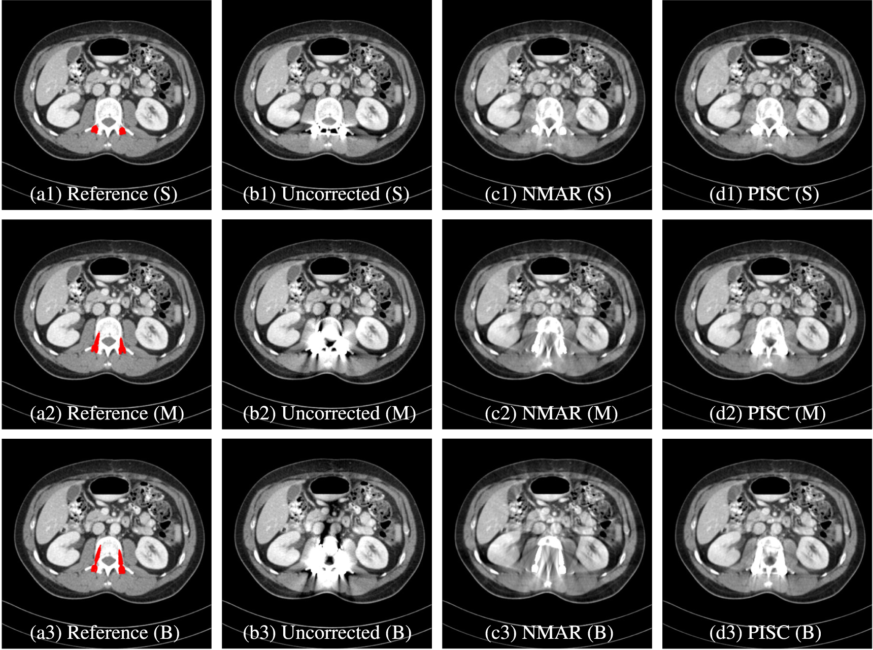 Physics-informed sinogram completion for metal artifact reduction in CT ...