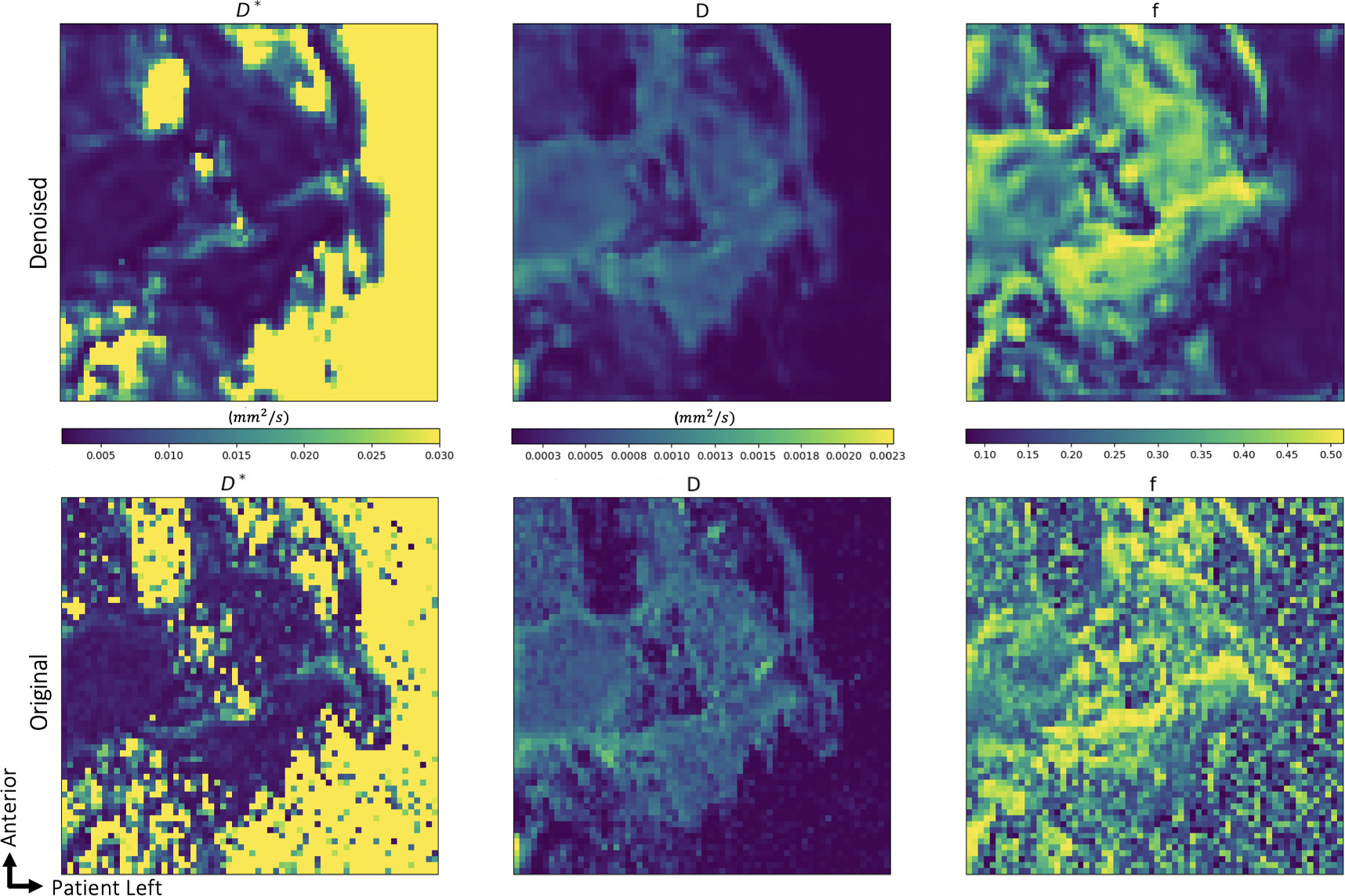 Image denoising and model-independent parameterization for IVIM MRI ...