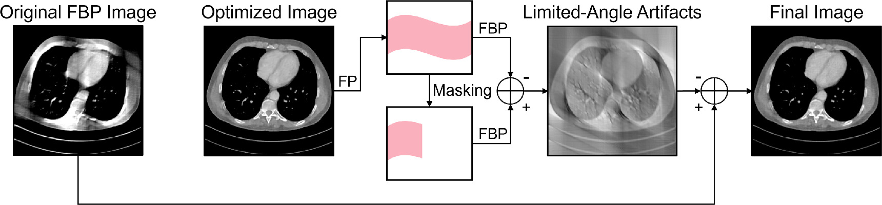Iterative reconstruction for limited-angle CT using implicit neural ...