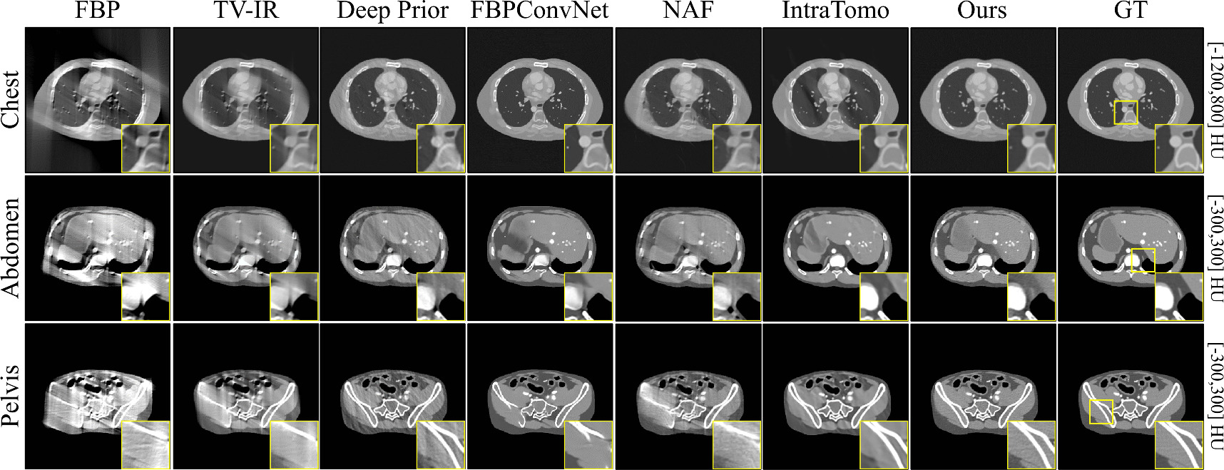 Iterative reconstruction for limited-angle CT using implicit neural ...