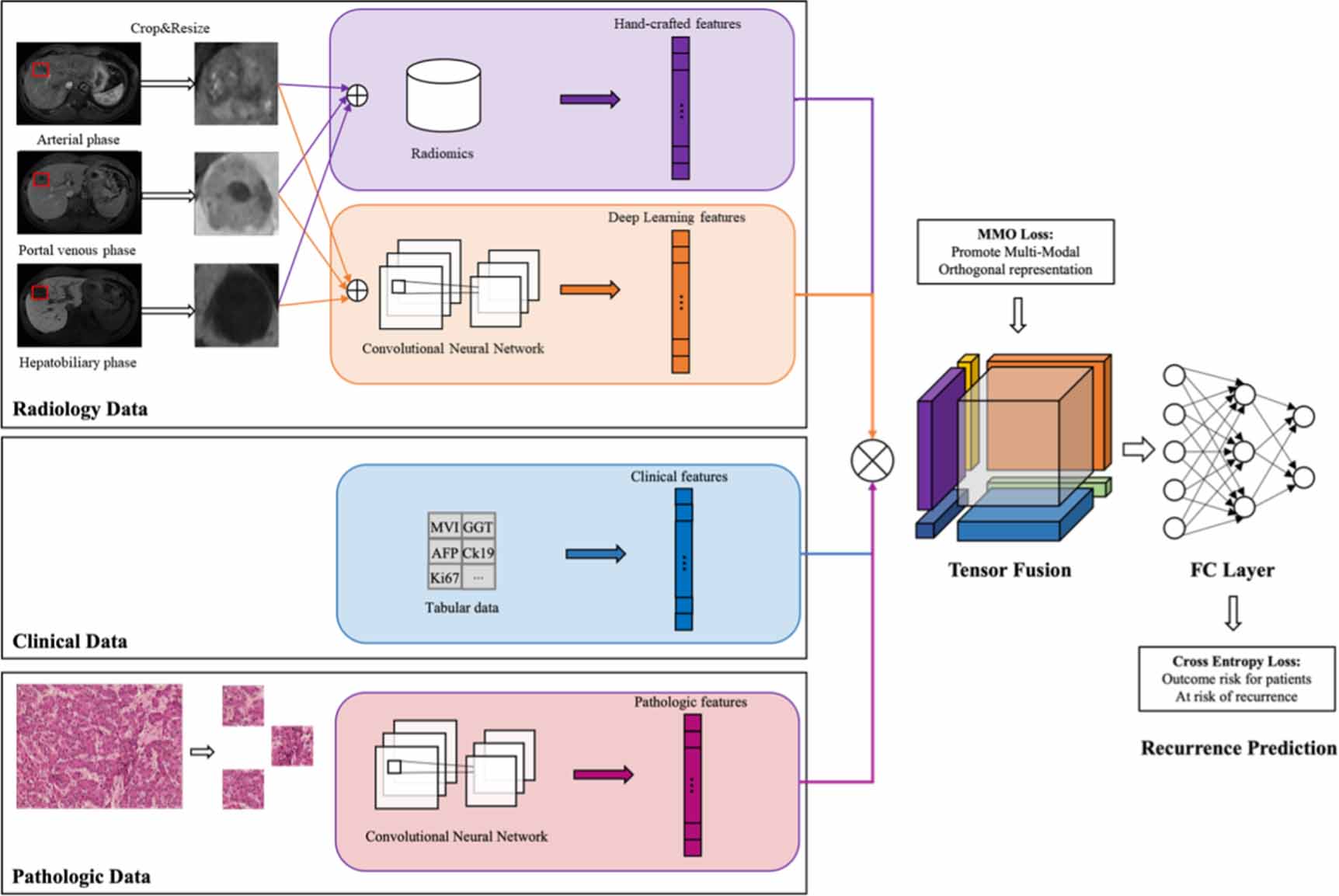 Prediction model of early recurrence of multimodal hepatocellular ...