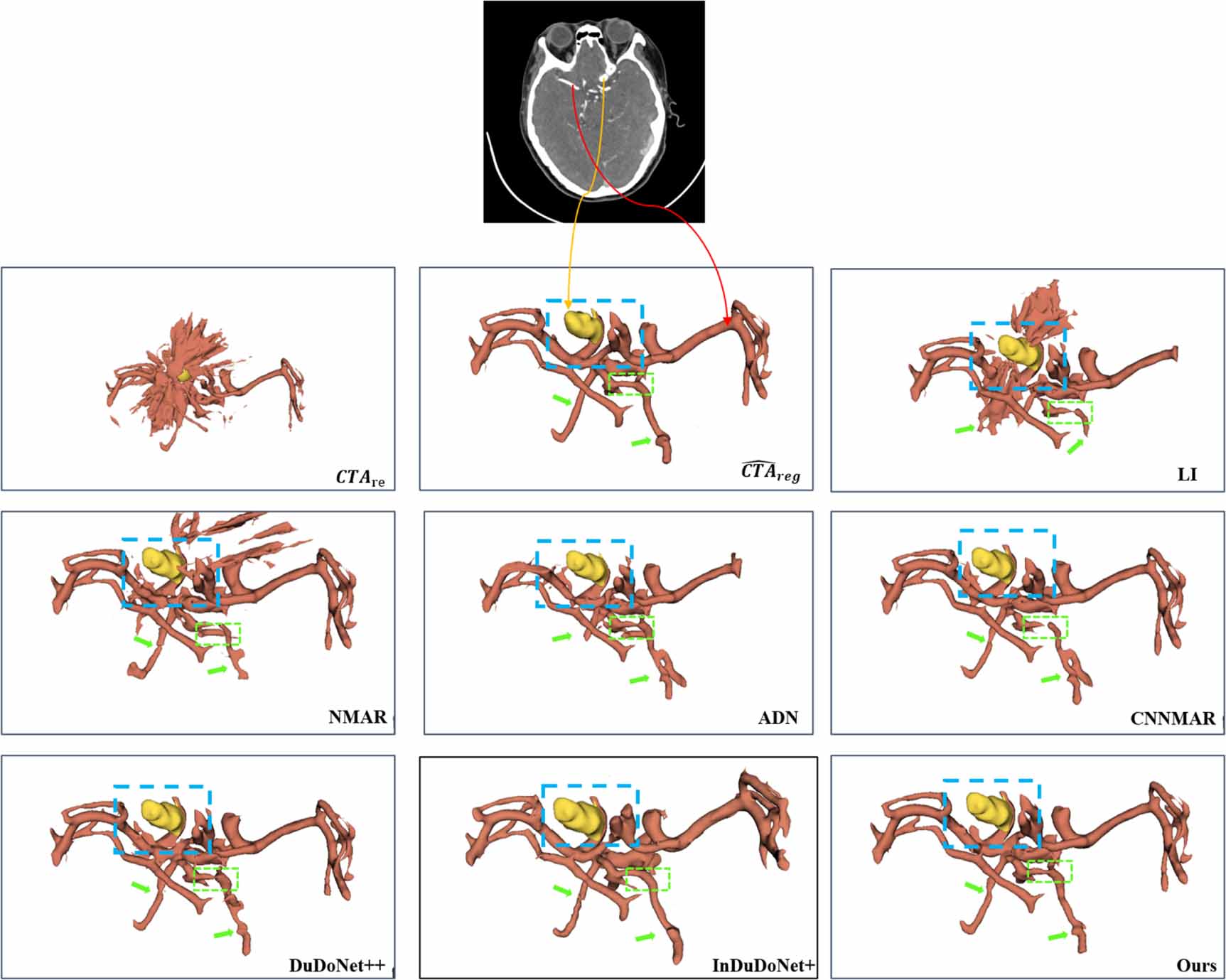ReMAR: a preoperative CT angiography guided metal artifact reduction ...