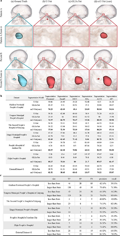 Deep learning for intracranial aneurysm segmentation using CT ...