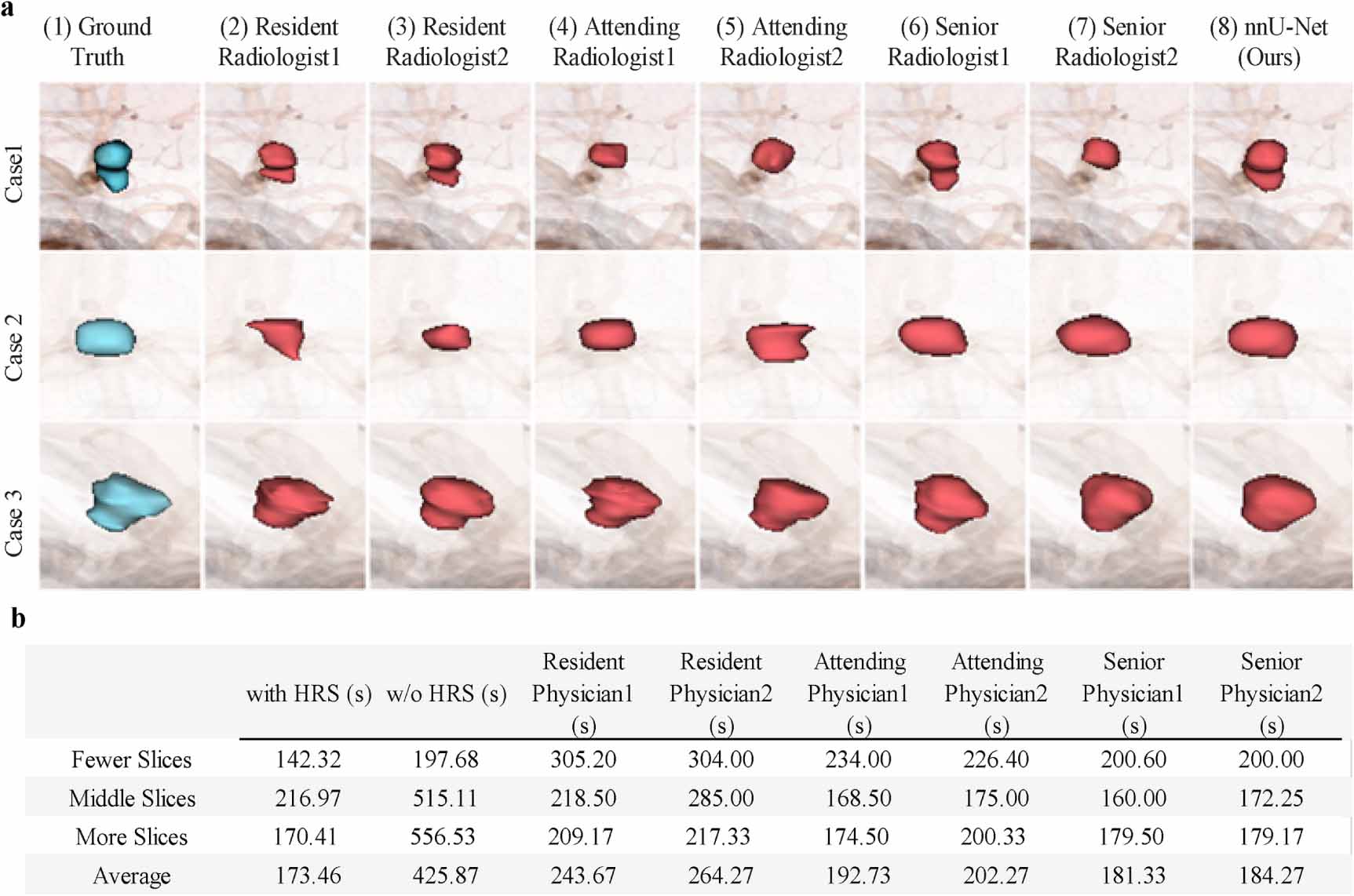 Deep learning for intracranial aneurysm segmentation using CT ...