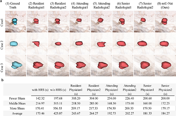Deep learning for intracranial aneurysm segmentation using CT ...