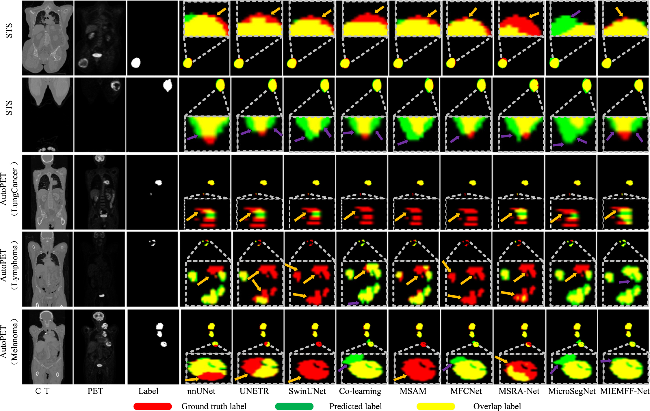 Joint segmentation of tumors in 3D PET-CT images with a network fusing ...