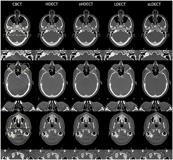 Exploring dual energy CT synthesis in CBCT-based adaptive radiotherapy ...