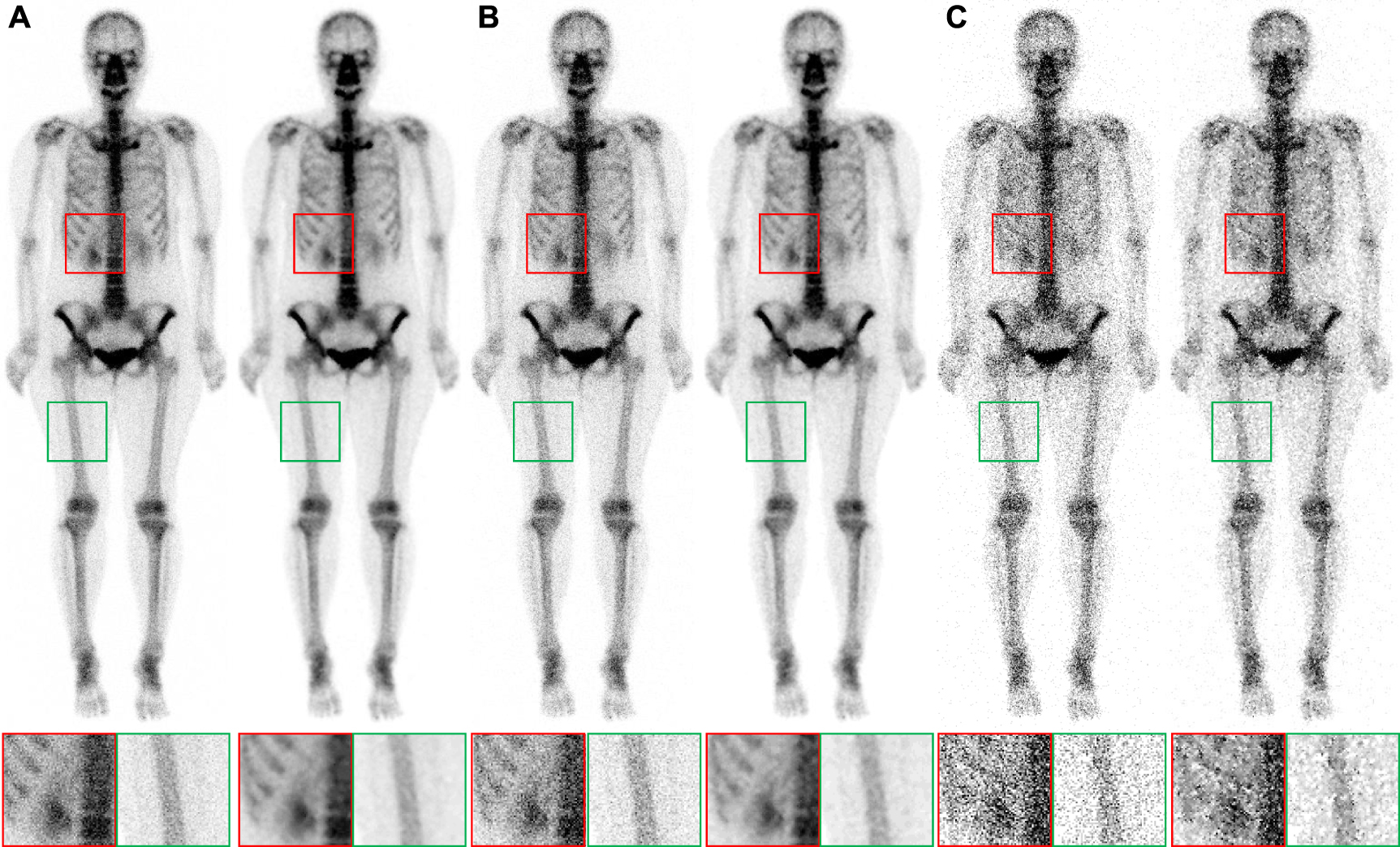 Enhancing bone scan image quality: an improved self-supervised ...