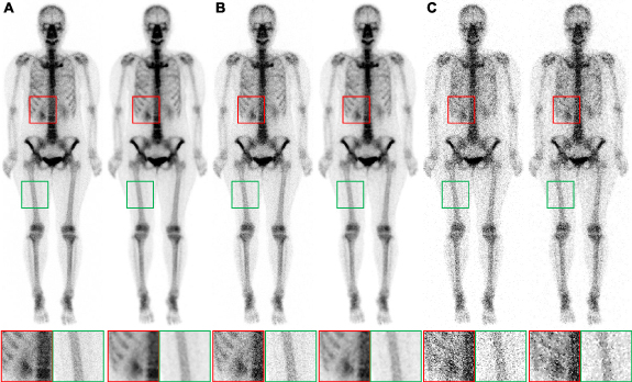 Enhancing bone scan image quality: an improved self-supervised ...