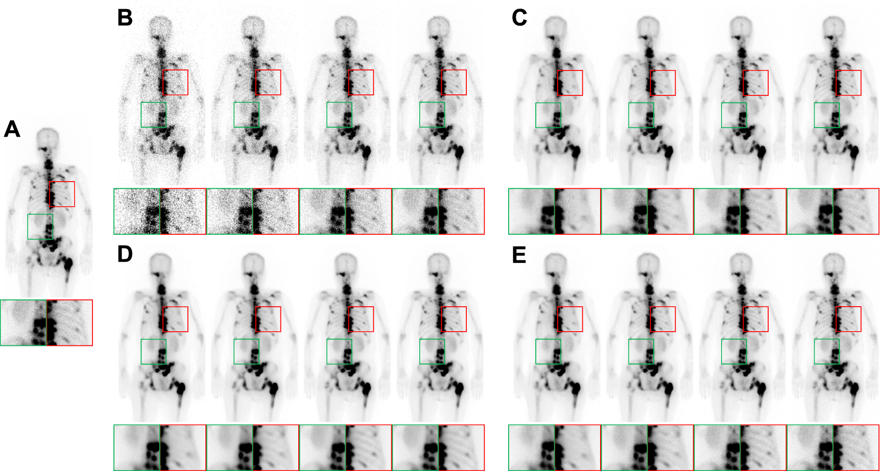 Enhancing bone scan image quality: an improved self-supervised ...