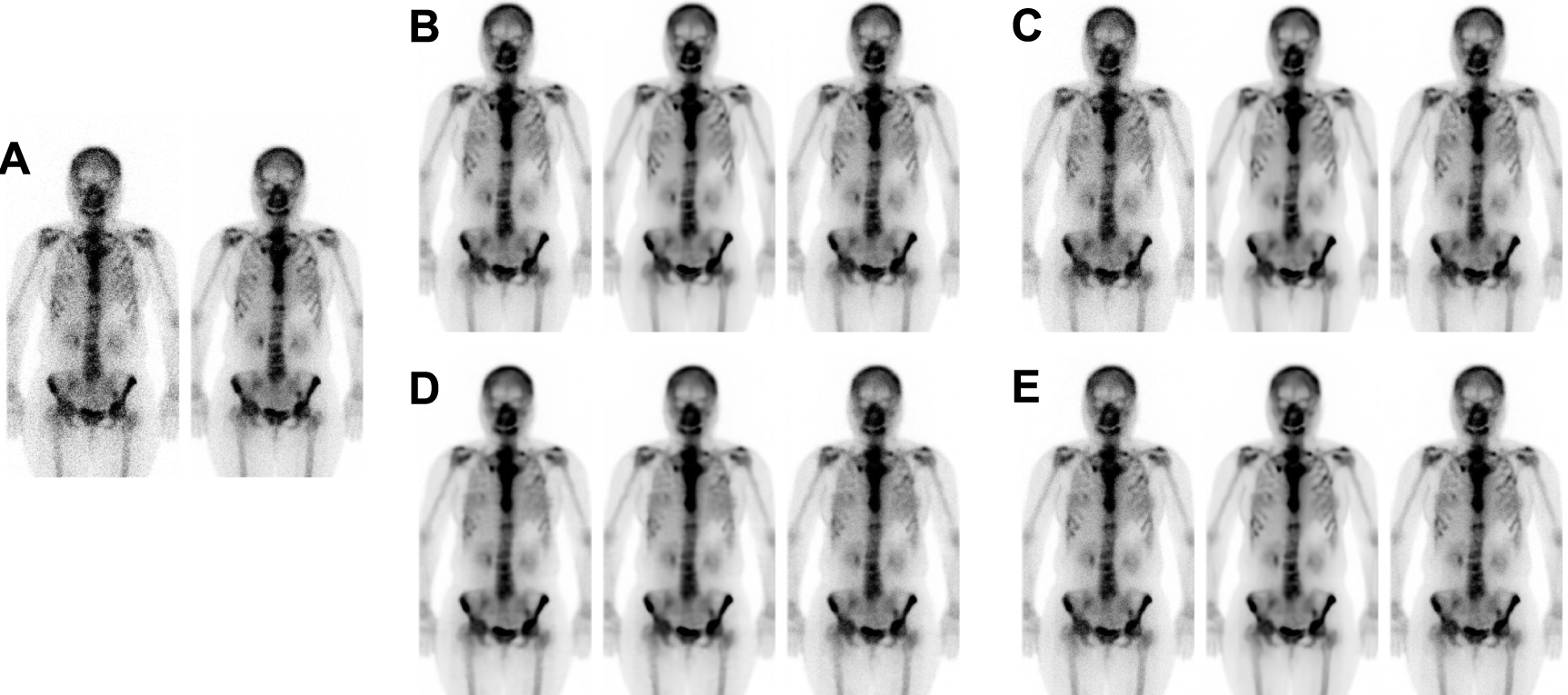 Enhancing bone scan image quality: an improved self-supervised ...