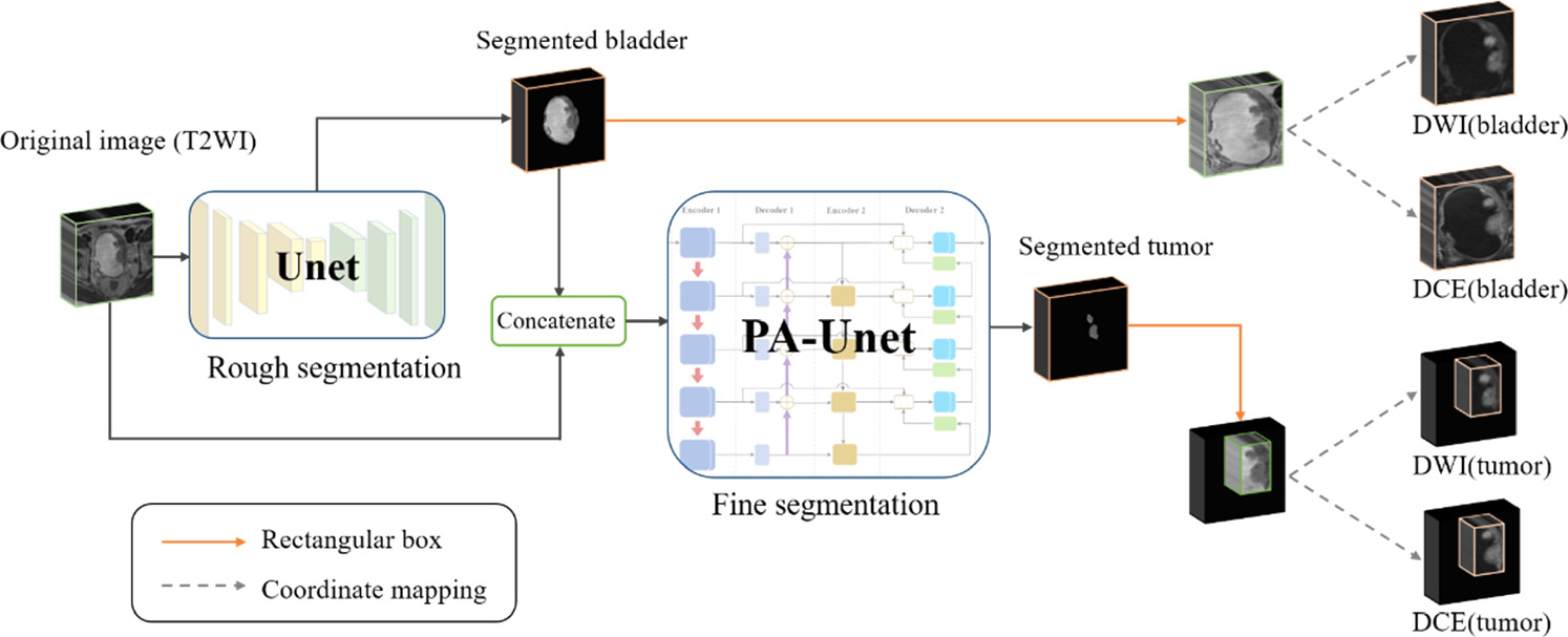 A novel predict method for muscular invasion of bladder cancer based on ...