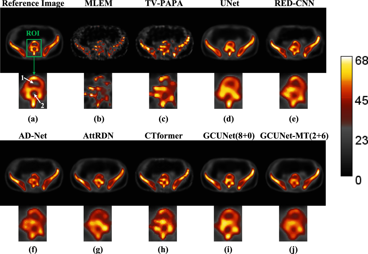Semi-supervised low-dose SPECT restoration using sinogram inner ...