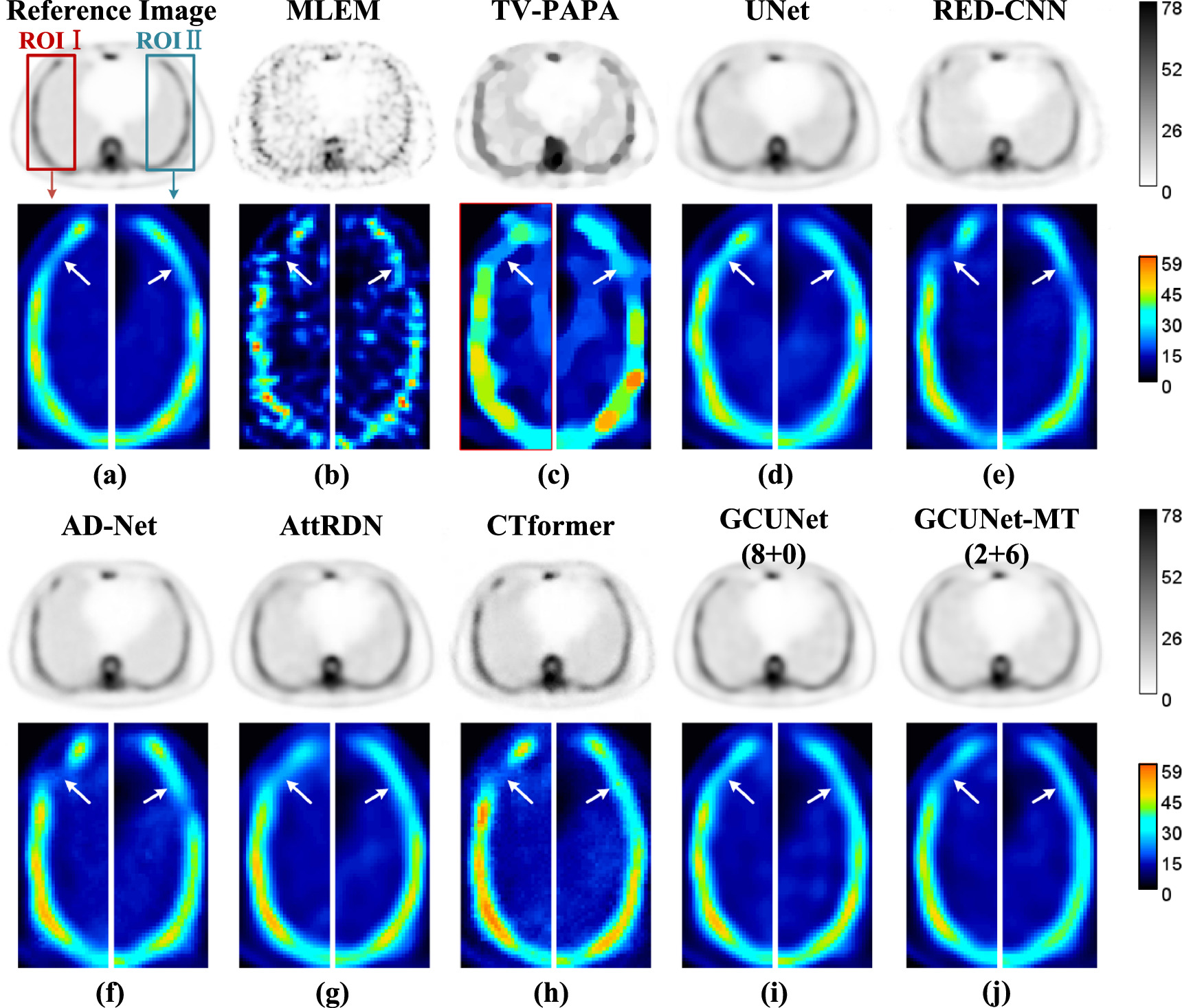 Semi-supervised low-dose SPECT restoration using sinogram inner ...