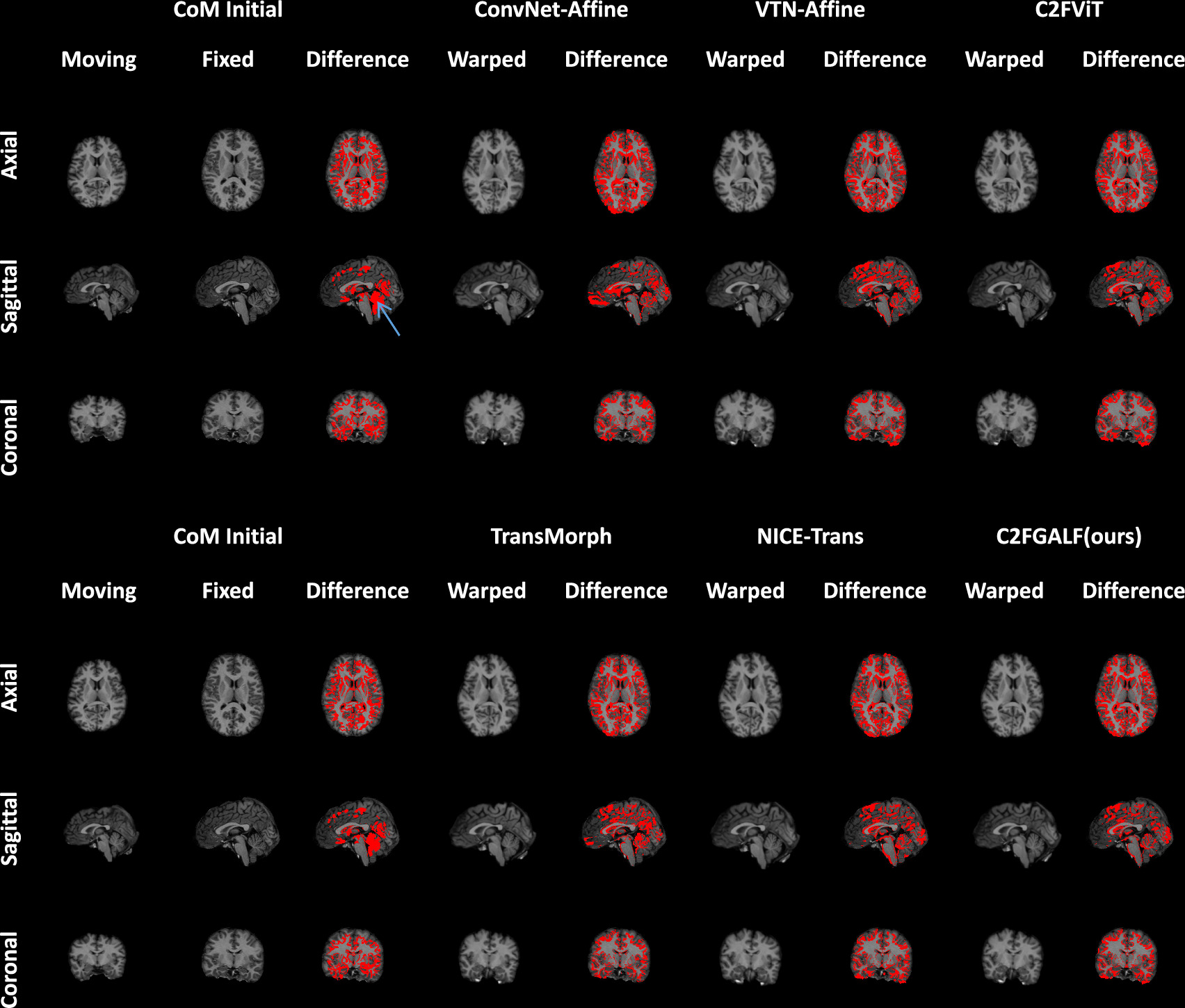 Affine medical image registration with fusion feature mapping in local ...