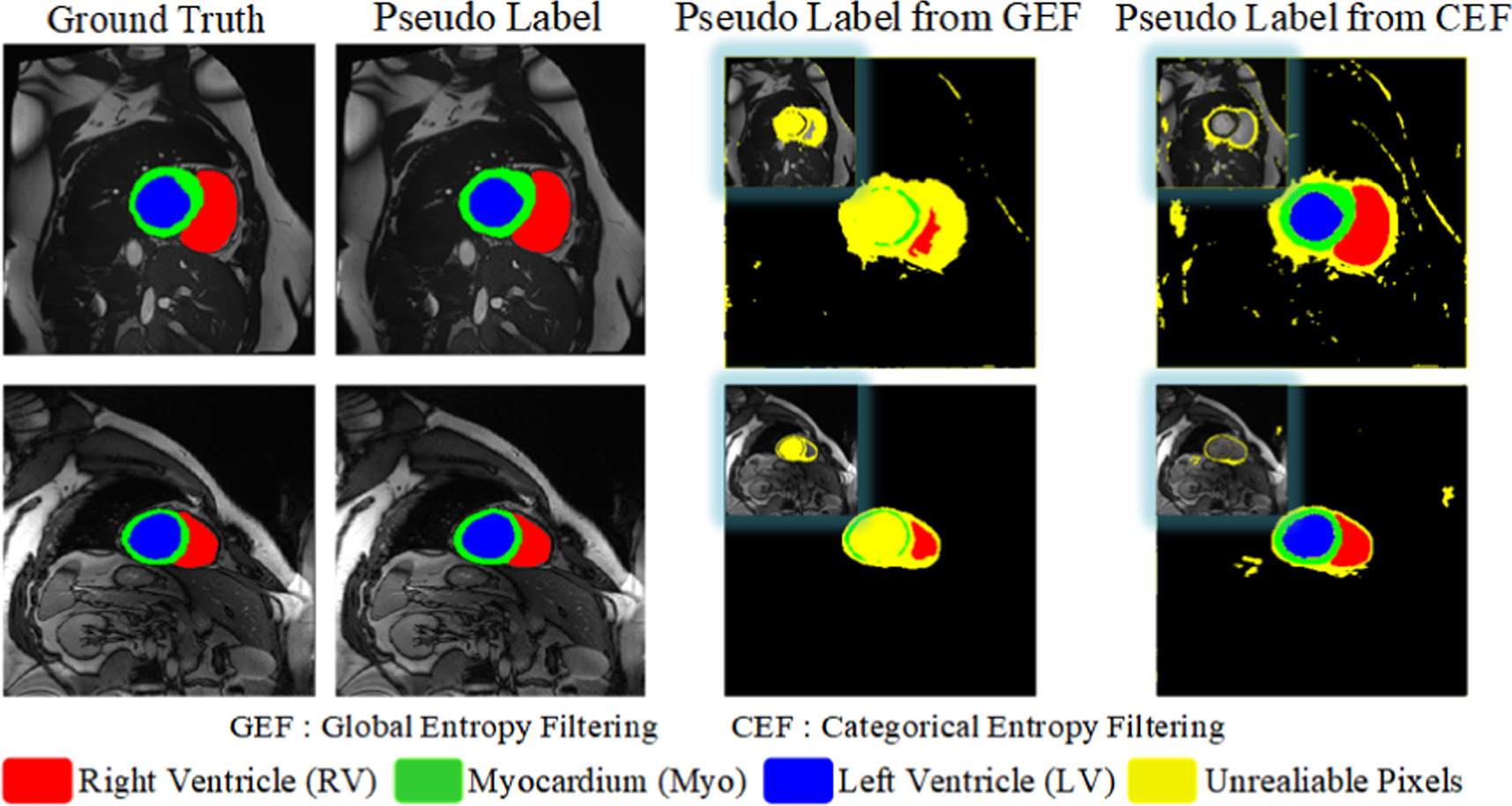 MDT: semi-supervised medical image segmentation with mixup-decoupling ...