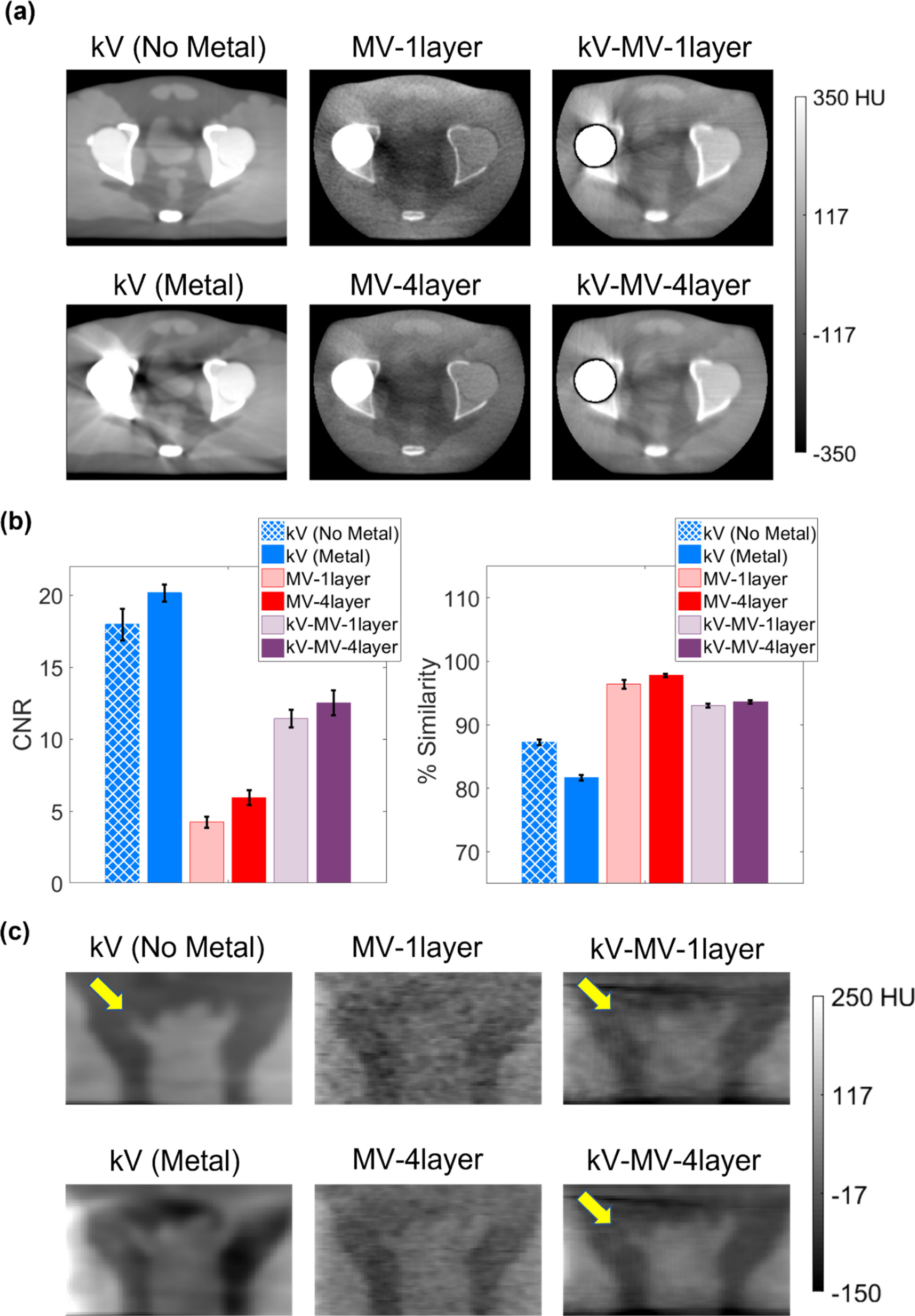 A kV–MV approach to CBCT metal artifact reduction using multi-layer MV ...