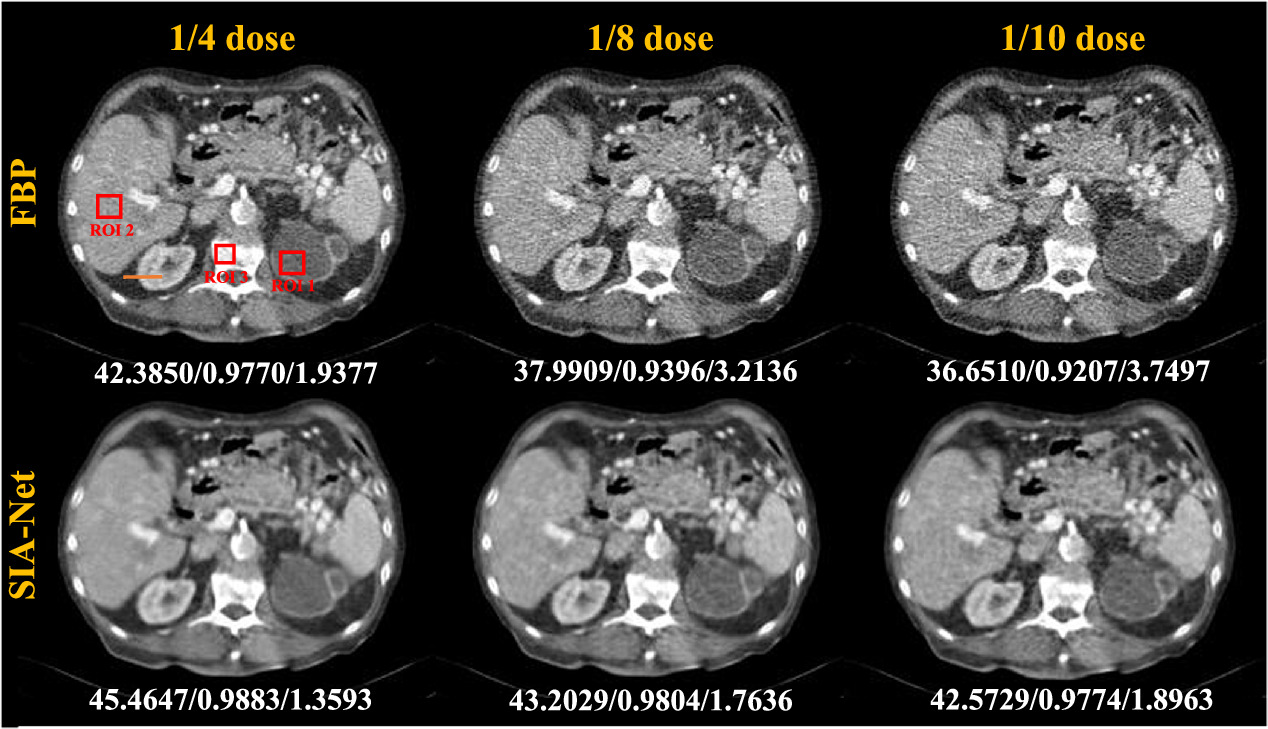 Semi-supervised iterative adaptive network for low-dose CT sinogram ...