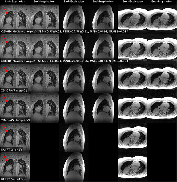 Infinity Rods Mri High-definition motion-resolved MRI using 3D radial kooshball ...