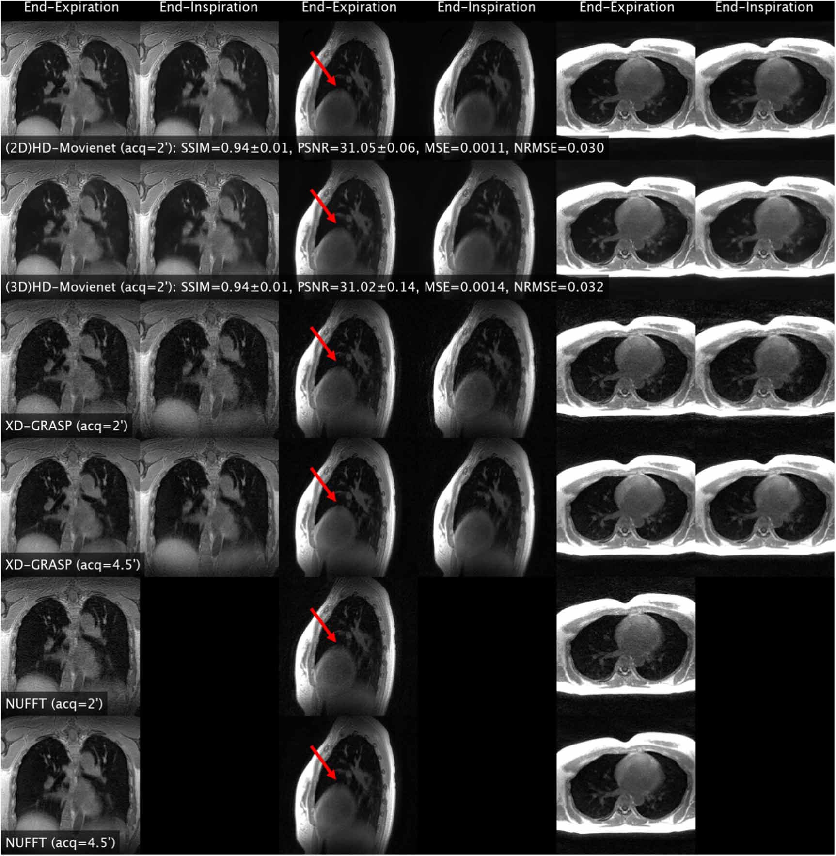 High-definition motion-resolved MRI using 3D radial kooshball ...