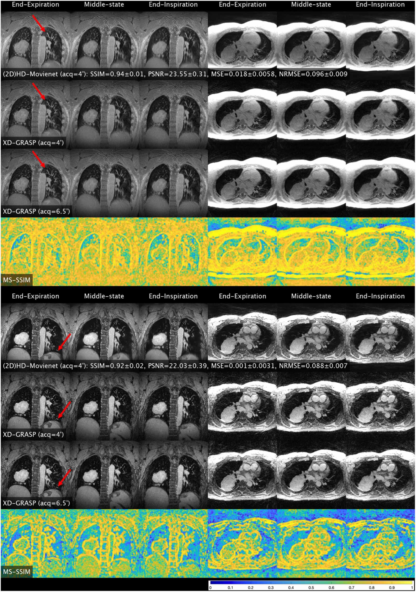High-definition motion-resolved MRI using 3D radial kooshball ...