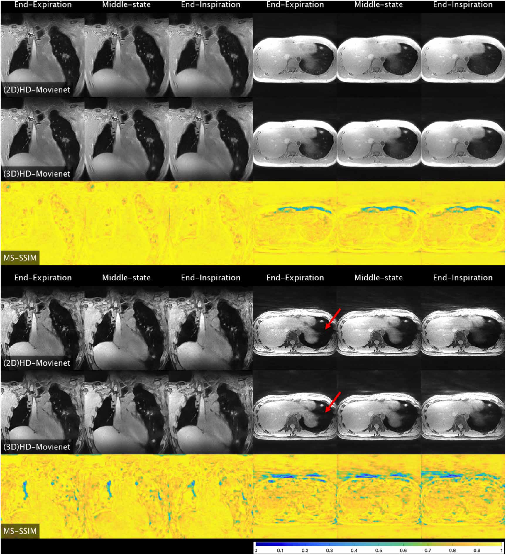 High-definition motion-resolved MRI using 3D radial kooshball ...
